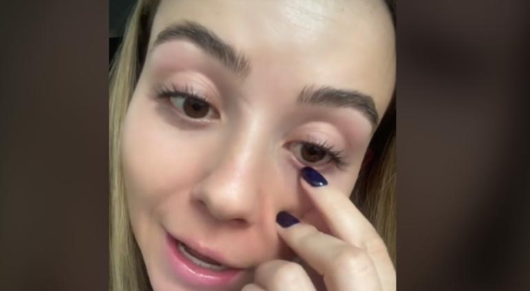 Mujer descubrió un gusano dentro de su ojo después de ¡4 años!