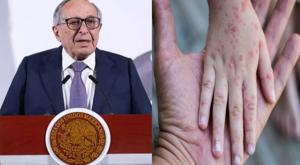 Relacionada mexico-registro-mas-de-4-mil-casos-de-sarampion-y-17-muertes.jpg
