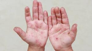 Relacionada virus-coxsackie.jpg