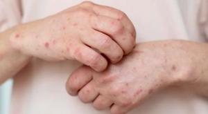 Relacionada sarampion.jpg