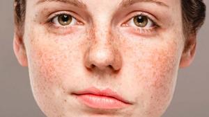 Relacionada paralisis-facial.jpg