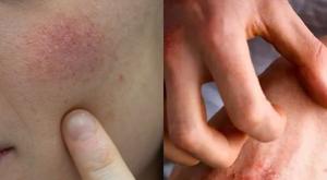 Relacionada piel-reseca.jpg