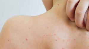 Relacionada principal_sarampion.jpg