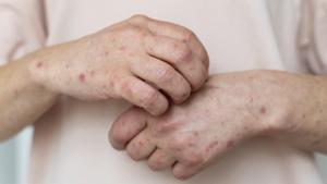 Relacionada sarampion-rubeola-y-paperas-preguntas-frecuentes-1024x681.jpg