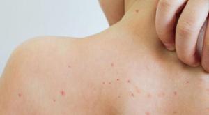 Relacionada principal_principal_sarampion.jpg