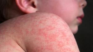 Relacionada sarampion.jpg