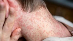 Relacionada sarampion-1080x675.jpg