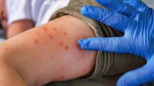 Relacionada principal_sarampion-1024x683.jpg